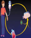 Gene therapy